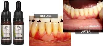 Dental Pro 7 Before And After