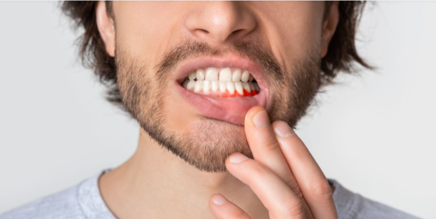 Can Your Gums Grow Back After Receding