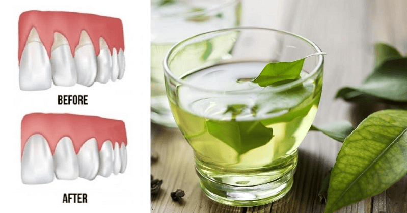 receding gums natural remedies