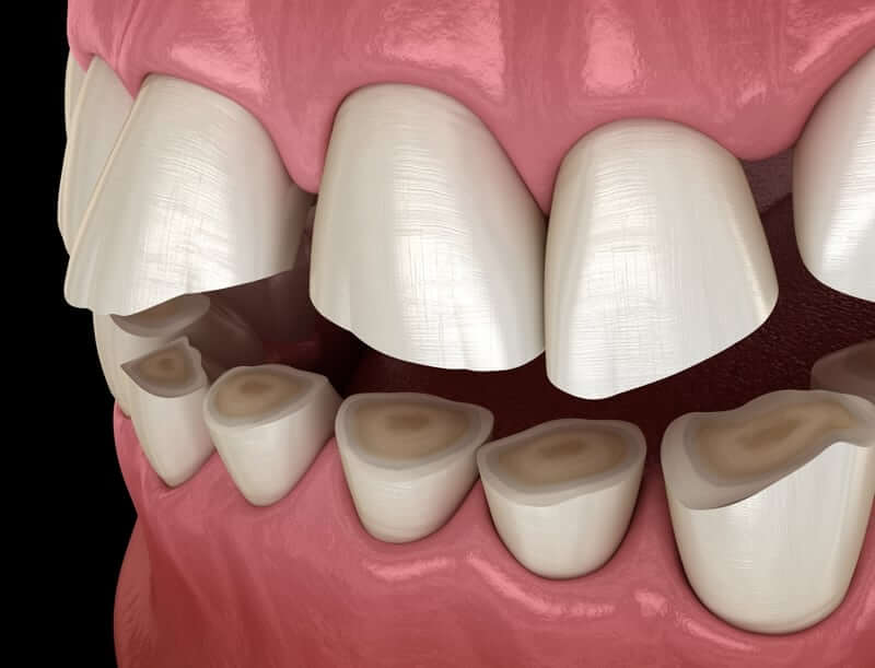 Avoid Teeth Grinding